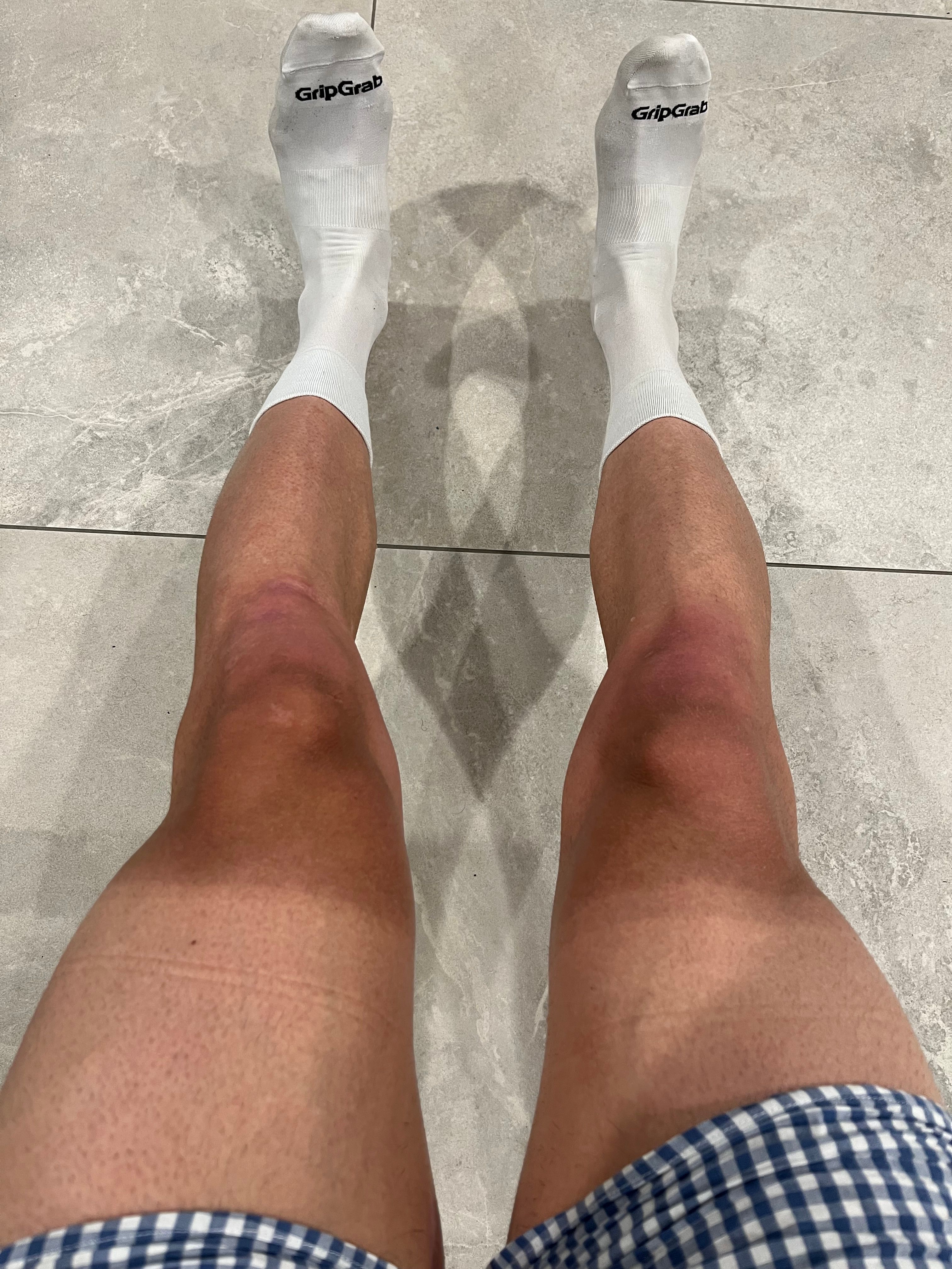 Cooking the tanlines.
